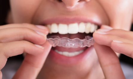 Dos and Don’ts of Eating After Getting an Invisalign Treatment