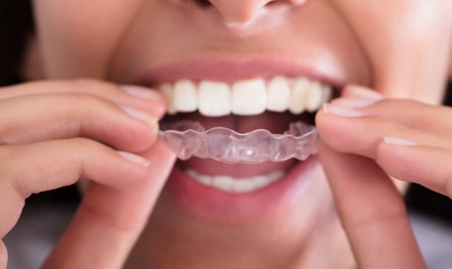 Dos and Don’ts of Eating After Getting an Invisalign Treatment
